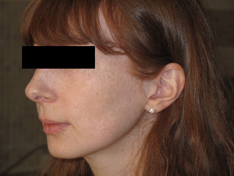 freckles-left-after